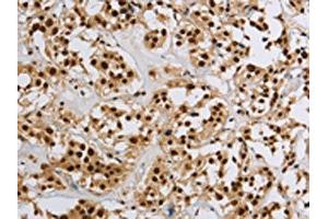 The image on the left is immunohistochemistry of paraffin-embedded Human thyroid cancer tissue using ABIN7190953(HIST1H2AB Antibody) at dilution 1/20, on the right is treated with synthetic peptide. (HIST1H2AB 抗体)