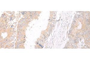 Immunohistochemistry of paraffin-embedded Human colorectal cancer tissue using HLA-C Polyclonal Antibody at dilution of 1:25(x200) (HLA-C 抗体)