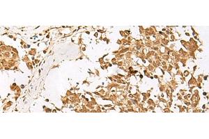 Immunohistochemistry of paraffin-embedded Human lung cancer tissue using PSMD12 Polyclonal Antibody at dilution of 1:40(x200) (PSMD12 抗体)