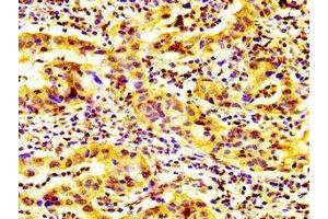 IHC image of ABIN7163593 diluted at 1:600 and staining in paraffin-embedded human bladder cancer performed on a Leica BondTM system. (GP6 抗体  (AA 115-265))