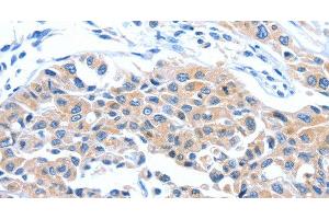 Immunohistochemistry of paraffin-embedded Human lung cancer tissue using ARL11 Polyclonal Antibody at dilution 1:50 (ARL11 抗体)
