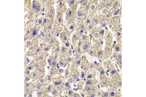Immunohistochemistry of paraffin-embedded Human liver injury using MPP2 antibody at dilution of 1:100 (x400 lens). (MPP2 抗体)