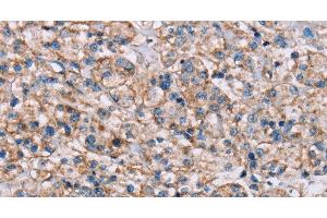 Immunohistochemistry of paraffin-embedded Human prostate cancer tissue using ADAM12 Polyclonal Antibody at dilution 1:40 (ADAM12 抗体)