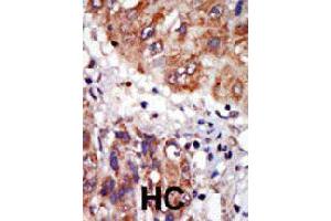 Formalin-fixed and paraffin-embedded human hepatocellular carcinoma tissue reacted with LIMK1 polyclonal antibody  , which was peroxidase-conjugated to the secondary antibody, followed by DAB staining. (LIM Domain Kinase 1 抗体  (N-Term))