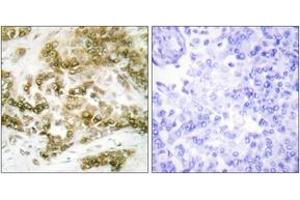 Immunohistochemistry analysis of paraffin-embedded human breast carcinoma tissue, using TBX15/18 Antibody. (T-Box 15/18 抗体  (AA 161-210))