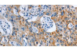 Immunohistochemistry of paraffin-embedded Human lung cancer tissue using ASL Polyclonal Antibody at dilution 1:35 (ASL 抗体)