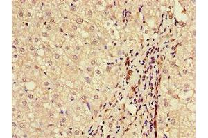 Immunohistochemistry of paraffin-embedded human liver cancer using ABIN7145589 at dilution of 1:100 (BAAT 抗体  (AA 313-400))