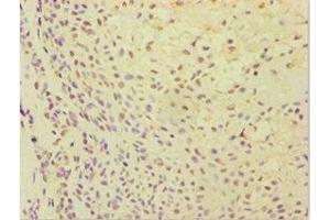 Immunohistochemistry of paraffin-embedded human breast cancer using ABIN7144870 at dilution of 1:100 (ATP5J 抗体  (AA 1-108))