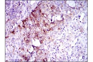 Immunohistochemical analysis of paraffin-embedded cervical cancer tissues using FLT3 mouse mAb with DAB staining.