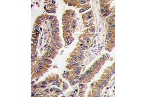 Formalin-fixed and paraffin-embedded human lung carcinoma tissue reacted with Bmp4 antibody (N-term), which was peroxidase-conjugated to the secondary antibody, followed by DAB staining. (BMP4 抗体  (N-Term))