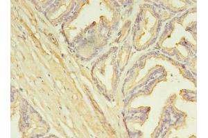 Immunohistochemistry of paraffin-embedded human prostate cancer using ABIN7146360 at dilution of 1:100 (SLC25A25 抗体  (AA 1-189))