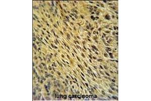 CCDC62 Antibody (C-term) (ABIN651350 and ABIN2840196) immunohistochemistry analysis in formalin fixed and paraffin embedded human lung carcinoma followed by peroxidase conjugation of the secondary antibody and DAB staining. (CCDC62 抗体  (C-Term))