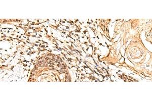 Immunohistochemistry of paraffin-embedded Human esophagus cancer tissue using RETREG1 Polyclonal Antibody at dilution of 1:60(x200) (FAM134B 抗体)