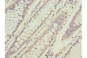Immunohistochemistry of paraffin-embedded human colon cancer using ABIN7173742 at dilution of 1:100 (TBCC 抗体  (AA 2-346))