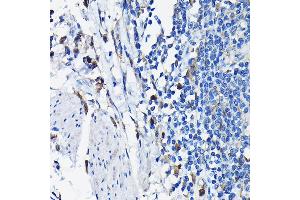 Immunohistochemistry of paraffin-embedded human colon carcinoma using STK19 Rabbit pAb (ABIN6132689, ABIN6148598, ABIN6148600 and ABIN6217358) at dilution of 1:100 (40x lens). (STK19 抗体  (AA 75-364))