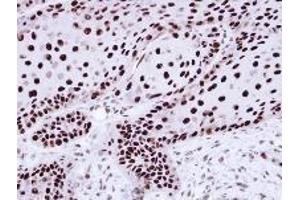AP19041PU-N hnRNP-C1/C2 antibody staining of Paraffin-Embedded Cal27 xenograft at 1/100 dilution. (HNRNPC 抗体  (N-Term))