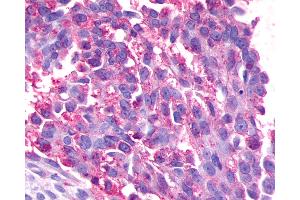 Anti-GPR17 antibody IHC of human Ovary, Carcinoma. (GPR17 抗体  (Cytoplasmic Domain))