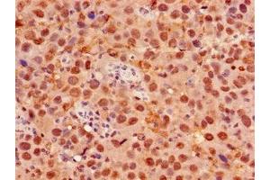 Immunohistochemistry of paraffin-embedded human pancreatic cancer using ABIN7153058 at dilution of 1:100 (Foxk1 抗体  (AA 621-730))