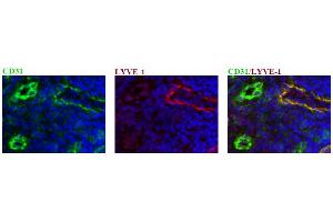 Immunohistochemical staining on cryosections from human colon carcinoma using anti-human LYVE-1 antibody DP3500 at 10ug/ml (pictures courtesy of Dr. (LYVE1 抗体  (AA 24-230))