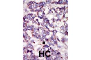 Formalin-fixed and paraffin-embedded human hepatocellular carcinoma tissue reacted with PDK2 polyclonal antibody  , which was peroxidase-conjugated to the secondary antibody, followed by DAB staining . (PDK2 抗体  (AA 378-407))