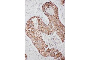 Anti-TNFAIP8L3 antibody, IHC(P) IHC(P): Human Mammary Cancer Tissue (TNFAIP8L3 抗体  (C-Term))