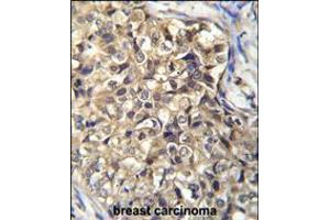 KLHL35 Antibody immunohistochemistry analysis in formalin fixed and paraffin embedded human breast carcinoma followed by peroxidase conjugation of the secondary antibody and DAB staining. (KLHL35 抗体  (C-Term))