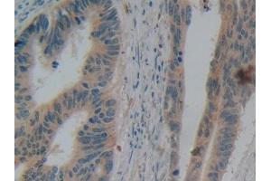 Detection of DEFb2 in Human Colorectal cancer Tissue using Polyclonal Antibody to Defensin Beta 2 (DEFb2)