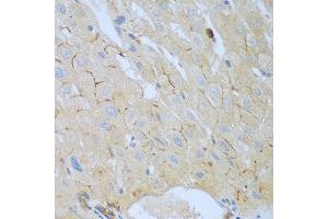 Immunohistochemistry of paraffin-embedded human liver cancer using CEACAM7 antibody at dilution of 1:100 (40x lens). (CEACAM7 抗体)