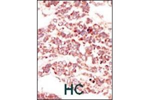 Formalin-fixed and paraffin-embedded human cancer tissue reacted with the primary antibody, which was peroxidase-conjugated to the secondary antibody, followed by DAB staining. (PTK7 抗体  (N-Term))