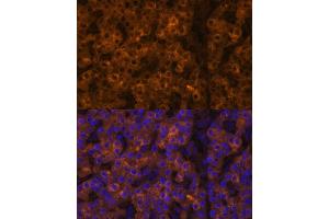 Immunofluorescence analysis of human liver cancer using TTR Polyclonal Antibody (ABIN3021473, ABIN3021474, ABIN3021475 and ABIN6215107) at dilution of 1:100 (40x lens). (TTR 抗体  (AA 21-147))