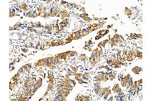 ABIN6256127 and ABIN6267130 at 1/100 staining Human colorectal cancer by IHC-P.