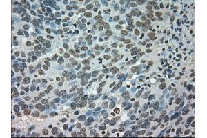 Immunohistochemical staining of paraffin-embedded Adenocarcinoma of colon tissue using anti-CTAG1Bmouse monoclonal antibody. (CTAG1B 抗体)