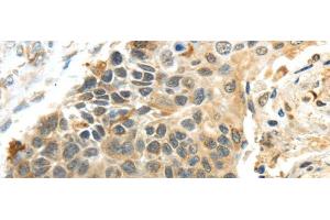 Immunohistochemistry of paraffin-embedded Human esophagus cancer using PROX1 Polyclonal Antibody at dilution of 1/40 (PROX1 抗体)