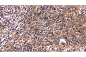 Immunohistochemistry of paraffin-embedded Human cervical cancer tissue using CRK Polyclonal Antibody at dilution 1:40 (Crk 抗体)