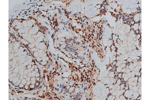 ABIN6255188 and ABIN6267444 at 1/50 staining human colon cancer tissue sections by IHC-P.