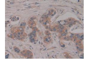 IHC-P analysis of Human Breast Cancer Tissue, with DAB staining. (PSG1 抗体  (AA 202-401))