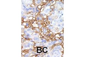 Formalin-fixed and paraffin-embedded human cancer tissue reacted with the primary antibody, which was peroxidase-conjugated to the secondary antibody, followed by DAB staining. (MAP4K1 抗体  (C-Term))
