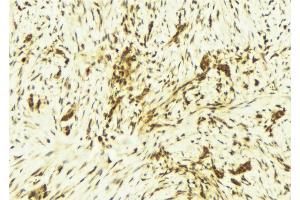 ABIN6269245 at 1/100 staining Human breast cancer tissue by IHC-P. (STAT1 抗体)