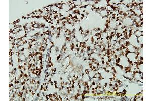 Immunoperoxidase of monoclonal antibody to CDKN1B on formalin-fixed paraffin-embedded human ovary, clear cell carcinoma tissue. (CDKN1B 抗体  (AA 1-198))