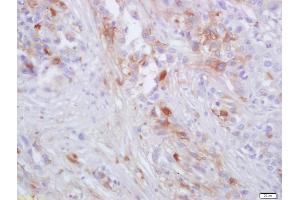 Formalin-fixed and paraffin embedded human lung carcinoma labeled with Anti-CCR-2 Polyclonal Antibody, Unconjugated (ABIN670146) at 1:200 followed by conjugation to the secondary antibody and DAB staining (CCR2 抗体)