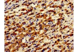 Immunohistochemistry of paraffin-embedded human liver cancer using ABIN7143372 at dilution of 1:100 (GPR124 抗体  (AA 1069-1338))