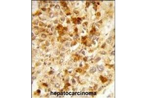 Formalin-fixed and paraffin-embedded human hepatocarcinoma reacted with PX Antibody (Center), which was peroxidase-conjugated to the secondary antibody, followed by DAB staining. (PEX2 抗体  (AA 165-194))