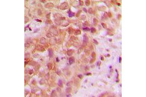 Immunohistochemical analysis of UBR5 staining in human breast cancer formalin fixed paraffin embedded tissue section. (UBR5 抗体  (N-Term))