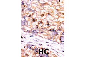 Formalin-fixed and paraffin-embedded human hepatocellular carcinoma tissue reacted with CTDSP1 polyclonal antibody  , which was peroxidase-conjugated to the secondary antibody, followed by DAB staining. (CTDSP1 抗体  (C-Term))