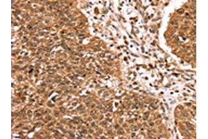 The image on the left is immunohistochemistry of paraffin-embedded Human lung cancer tissue using ABIN7192748(TCEB3B Antibody) at dilution 1/25, on the right is treated with synthetic peptide.