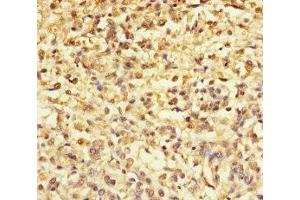 Immunohistochemistry of paraffin-embedded human melanoma using ABIN7172299 at dilution of 1:100 (TMEFF2 抗体  (AA 41-320))