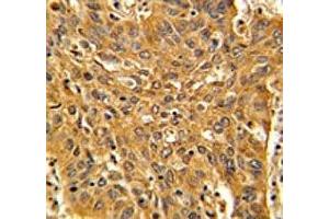 IHC analysis of FFPE human lung carcinoma with Fascin antibody (Fascin 抗体  (AA 322-350))