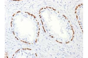 Formalin-fixed, paraffin-embedded human Prostate Carcinoma stained with p63 Mouse Monoclonal Antibody (TP63/2427). (p63 抗体)