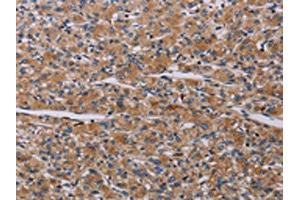 The image on the left is immunohistochemistry of paraffin-embedded Human prostate cancer tissue using ABIN7191790(PARP4 Antibody) at dilution 1/20, on the right is treated with synthetic peptide. (PARP4 抗体)