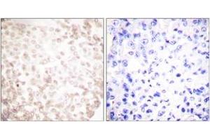 Immunohistochemistry analysis of paraffin-embedded human lung carcinoma tissue, using XRCC1 Antibody. (RCC1 抗体  (AA 517-566))